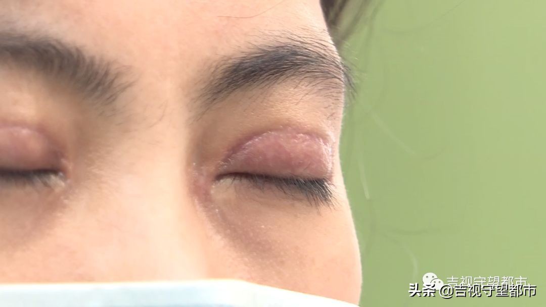 公寓做双眼皮效果好吗,私人公寓做的双眼皮失败了