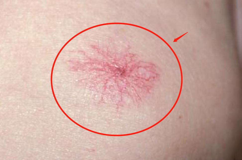 皮肤上长红痣要当心是肝病的征兆,有肝病前胸后背会出现小点红痣