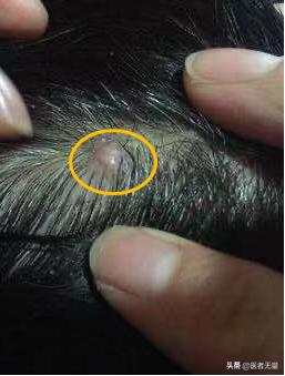 阴茎毛囊炎为什么反反复复,鼻孔毛囊炎反反复复怎么办