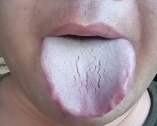 尿频尿急尿液有泡沫是肾病吗,湿气重小便会有什么症状