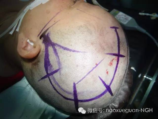 治疗脑梗死输什么液体最好,亚急性脑梗死怎么治疗最好