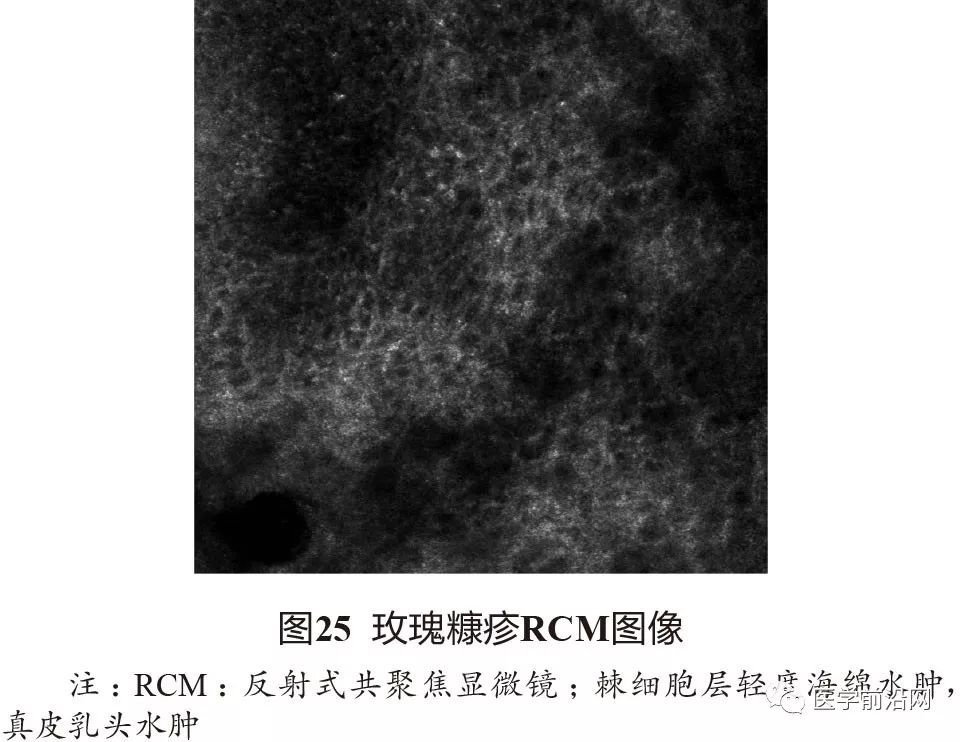 炎症性皮肤病反射式共聚焦显微镜诊断特征专家共识全文发布