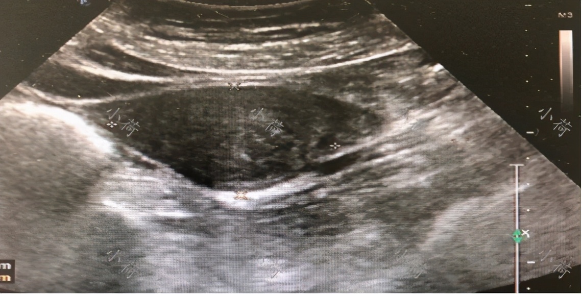 阴道持续出血10天，一位32岁宫颈癌患者的就诊经历