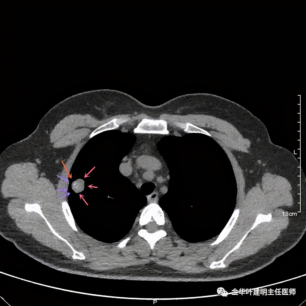 右上肺结节灶一般是什么癌,右上肺恶性肿瘤是肺癌吗