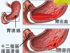 入秋后肠胃一直不舒服拉肚子,入秋肠胃不好怎么办