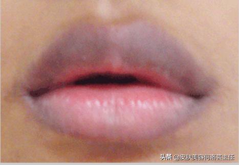 唇色发紫和唇色深,唇色深怎么办四大技巧改善唇色深