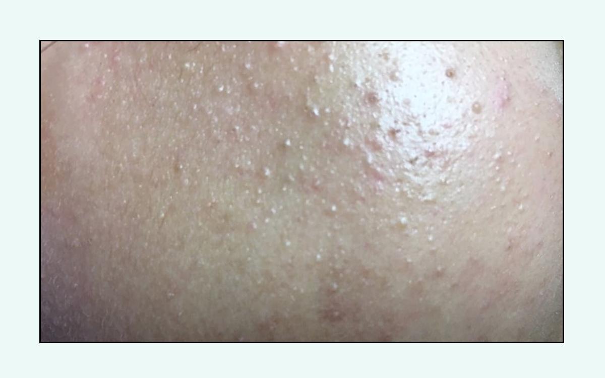 脸上的红疙瘩怎么彻底消除,脸上红疙瘩的种类