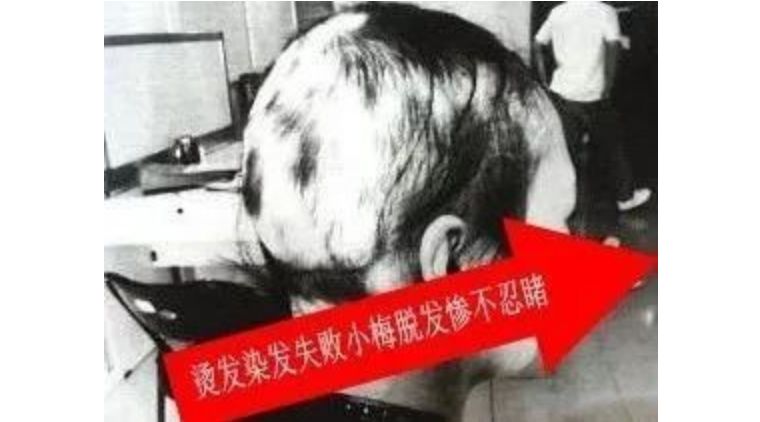 女人秃了一块怎么办,女性其实比男性秃