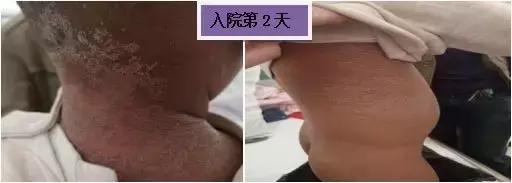 为什么手接触高温不会被烫伤,被烫伤的地方为什么会发热