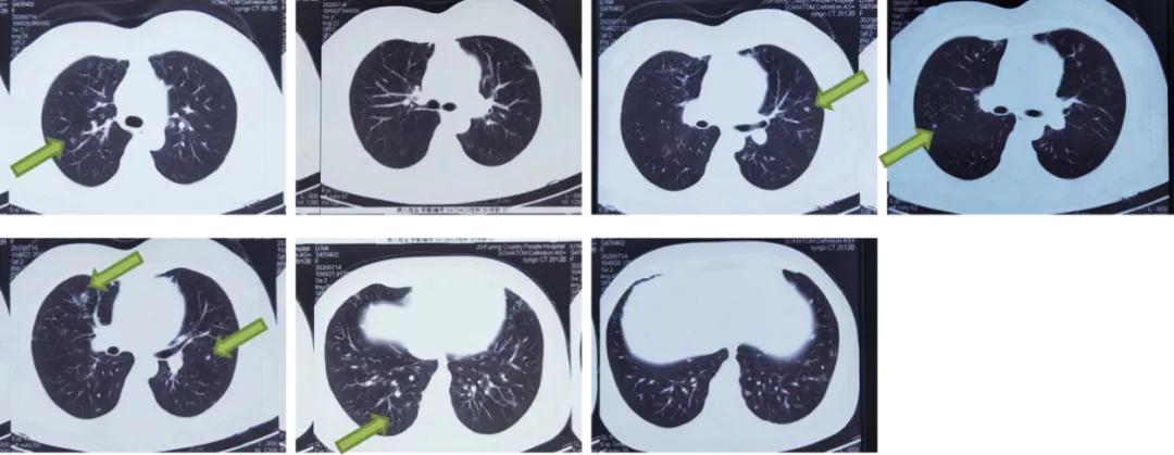 双肺多发结节，反复检查为何诊断重点成「盲区」？