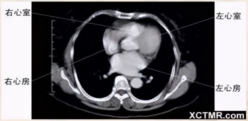 女性盆腔ct断层解剖结构图,女性盆腔脏器ct解剖