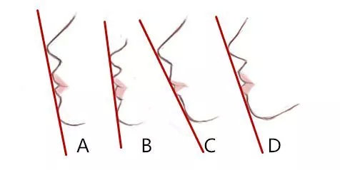 既有牙缝又有露龈笑先矫正哪个,儿童露龈笑最简单改善方法