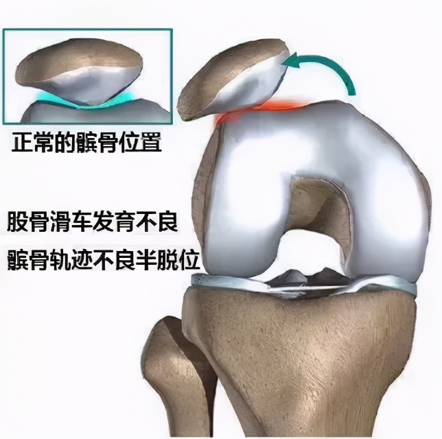 膝盖痛12种疼痛对照表图解,不同部位膝盖疼痛的原因