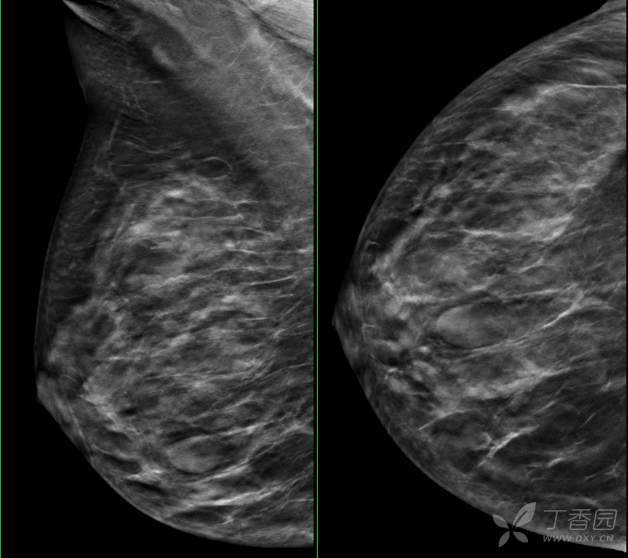 乳腺结节有消散的病例吗,一份完整的乳腺增生病例
