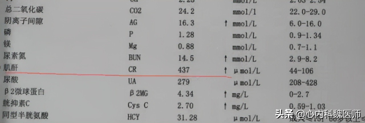 肌酐高要怎么降就知道严重性,肌酐高肾衰竭治愈偏方