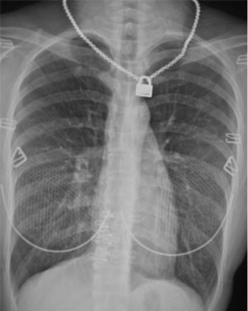 要照X光了，还要脱衣服？有必要这么麻烦吗？如何才能配合拍好？