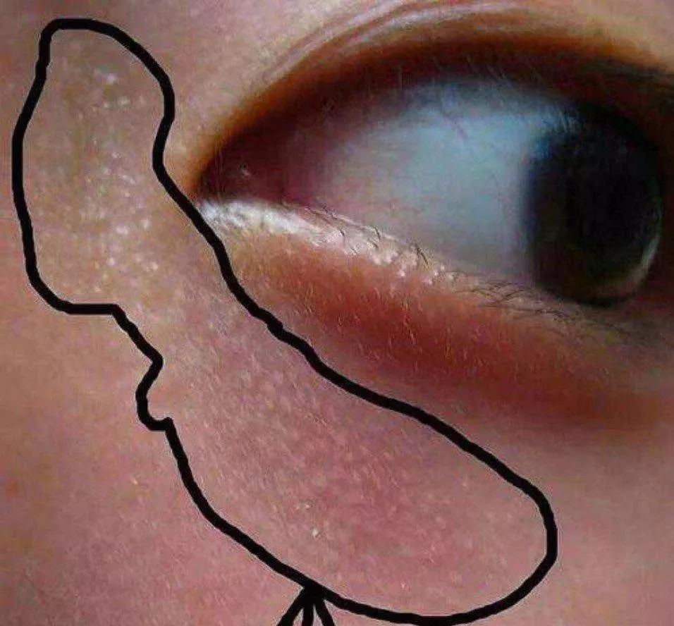 豁出小命说真话|脂肪粒真不是眼霜的错！粟丘疹这么做一针见效