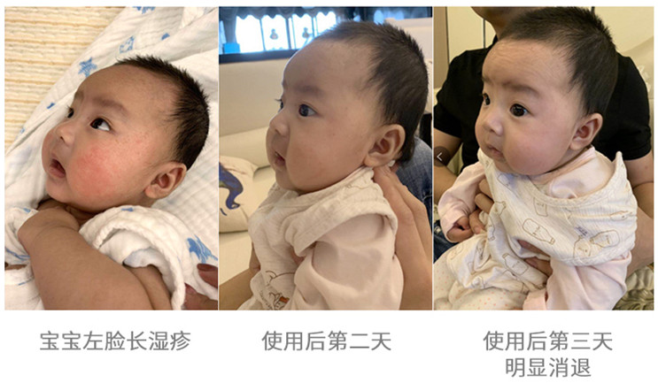 宝宝湿疹怎么护理,宝宝湿疹护理最有效