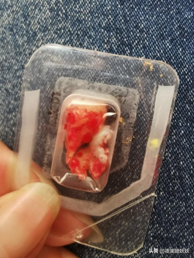 拔智齿横向阻生,拔智齿阻生牙是什么样