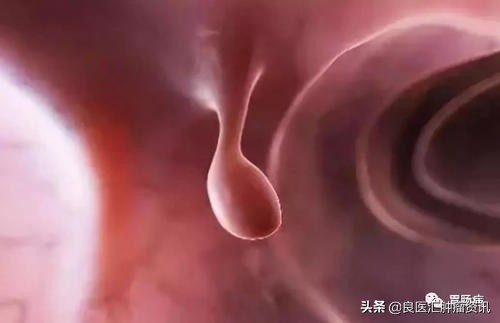 结节息肉囊肿有什么区别,增生结节囊肿息肉哪个更是肿瘤