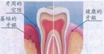 松了的牙齿好痒怎么办,松了两年的牙齿还可以补救吗