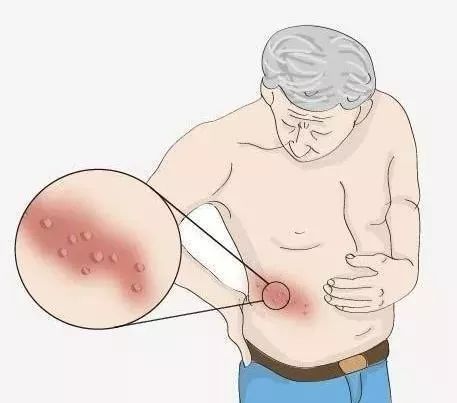 蛇盘疮围腰一圈会要人命吗,蛇缠腰和蛇盘疮是一回事吗