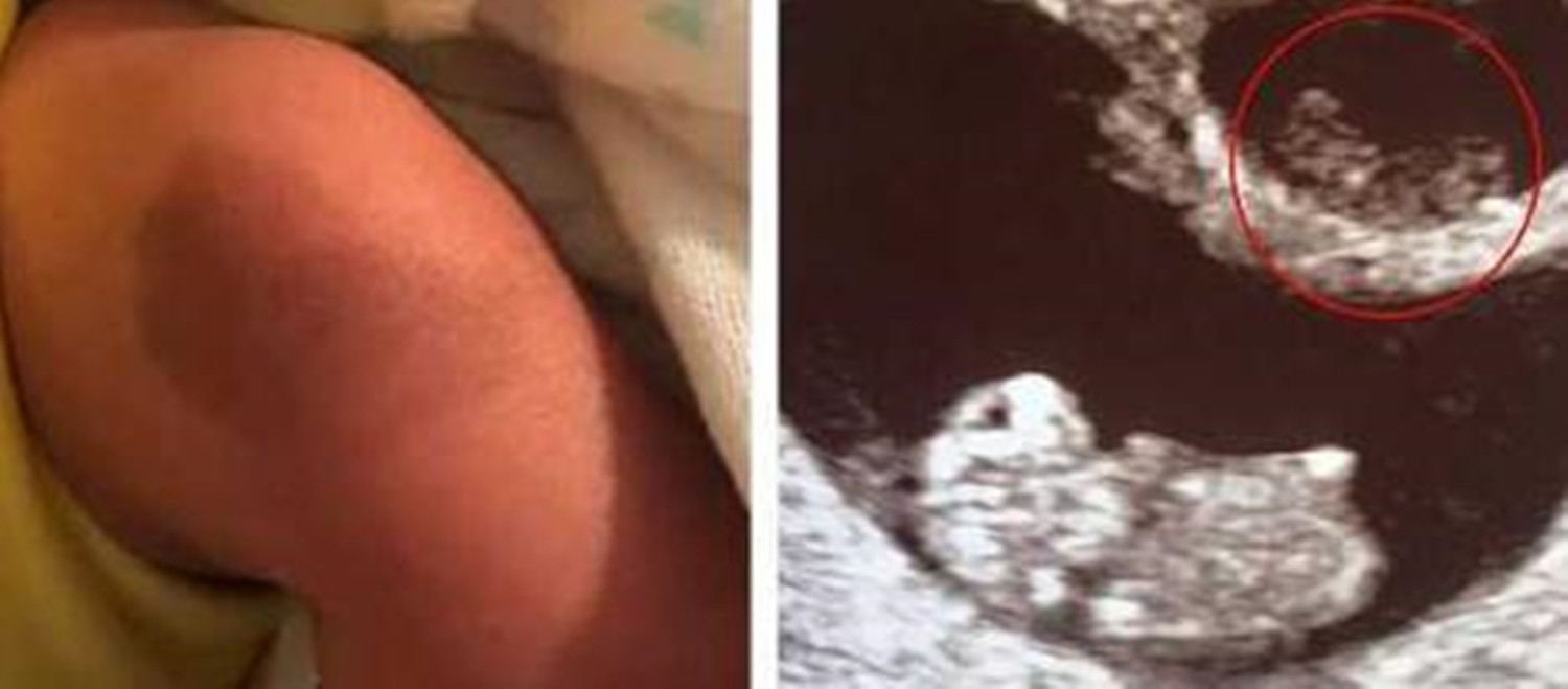 b超查得出胎儿长胎记吗,龙凤胎姐姐怀孕弟弟孕吐