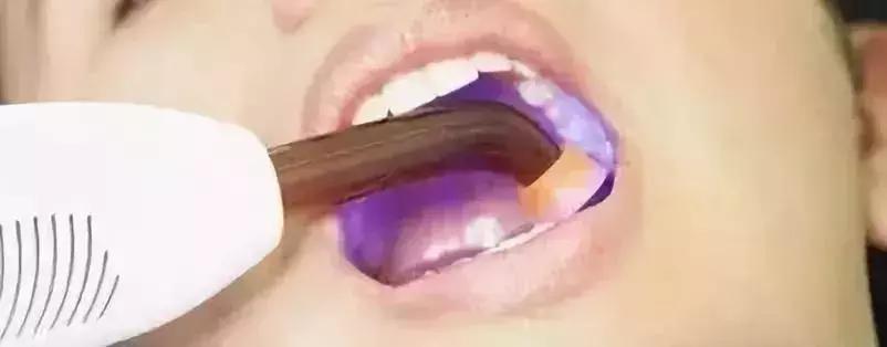 做根管治疗一定要问的问题,根管治疗为啥要做好几次