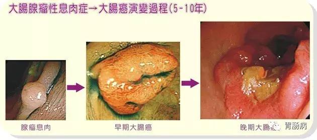 息肉明明切除了，为啥还是得了大肠癌？