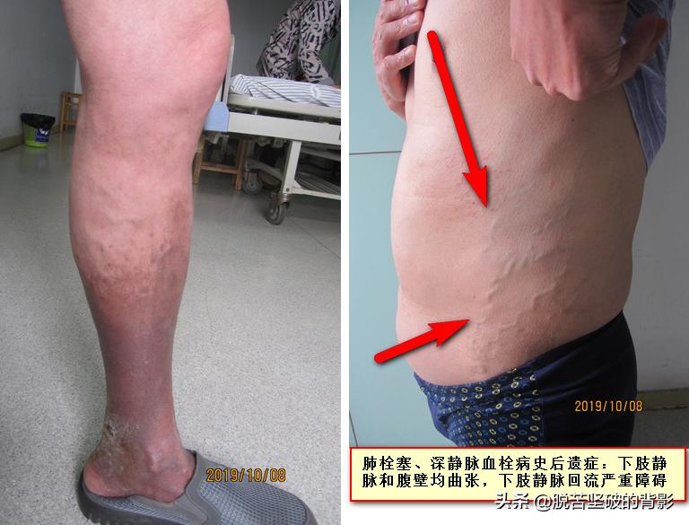 小小外伤4年8次住院，三甲医生举案说法：健康无小伤，手术须慎行