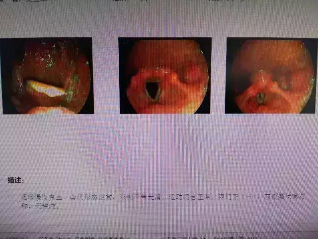 咽喉有异物感是喉癌吗,喉咙有异物感会是肿瘤吗