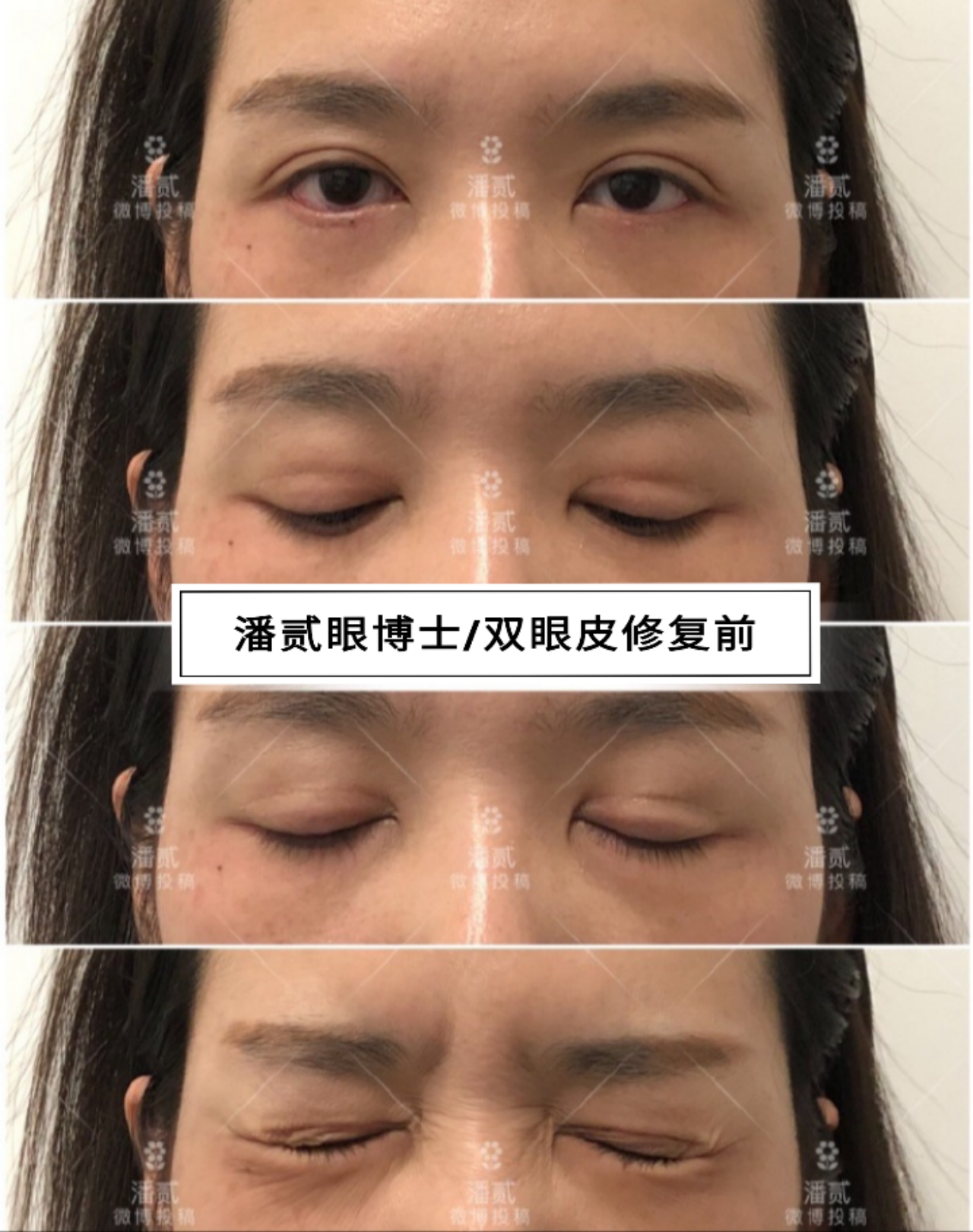 10个工作室做，9个毁，祛眼袋连卧蚕也没了，直接送我到10年后