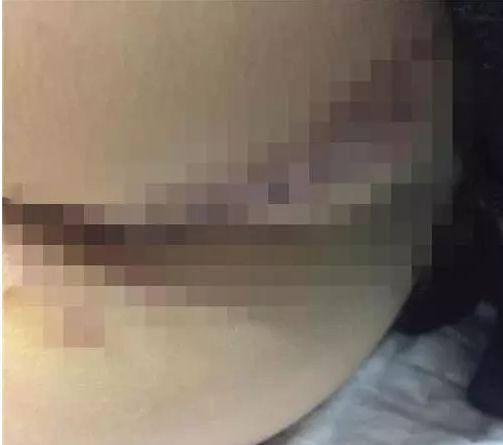 宝宝屁股受伤缝针,宝宝屁股缝针