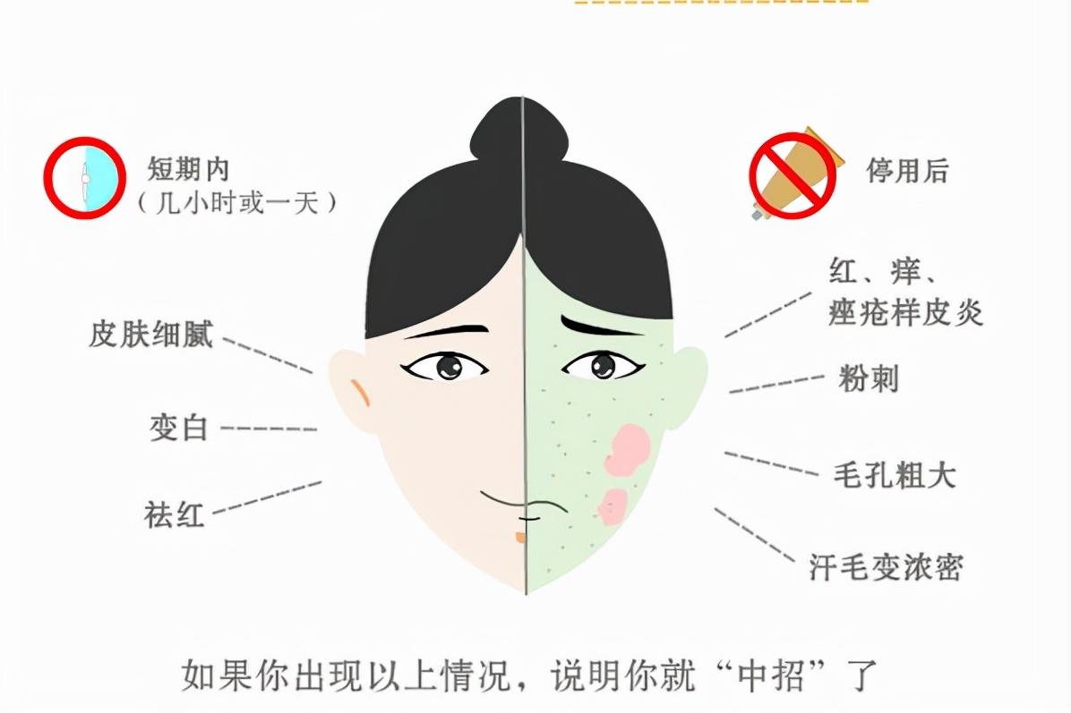 激素依赖性皮炎擦哪种药膏好,脸部过敏性皮炎十大药膏不含激素