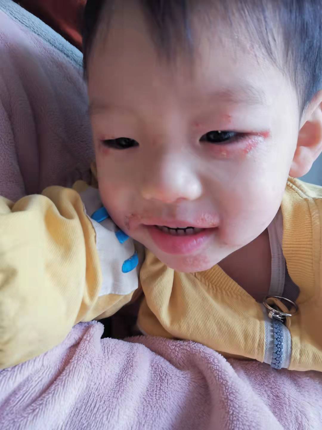 宝宝喝两个月奶粉后突然有湿疹了,4个月宝宝一喝奶粉就起湿疹