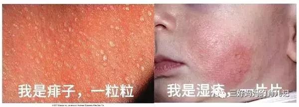 幼儿急疹和痱子怎么区分,宝宝急疹和痱子的区别