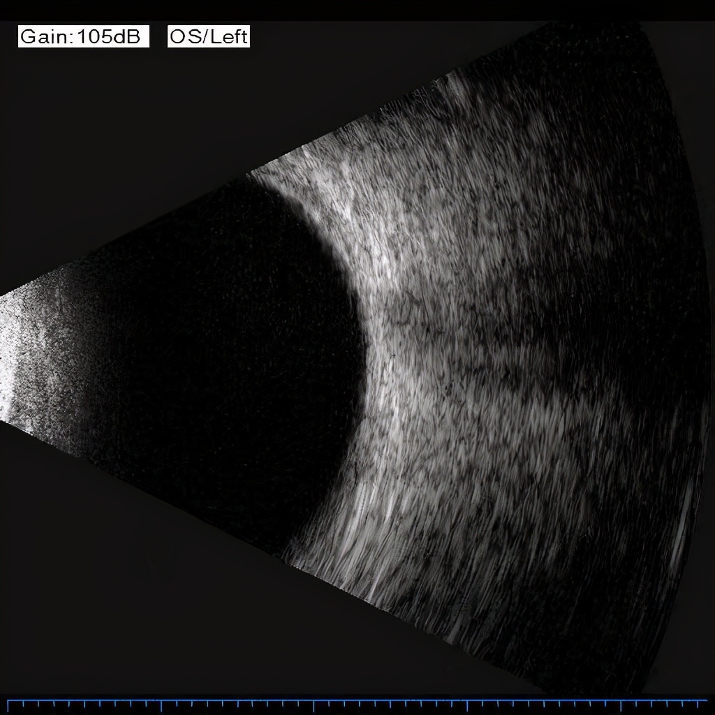 每分钟20000转,陈旧视网膜脱离治疗奇迹