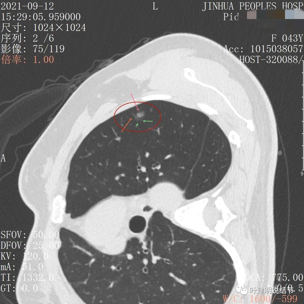 从活检怎么看是非小细胞癌,从病例谈辨证论治