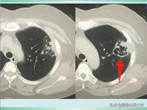 新冠肺炎对癌症有影响吗,癌症晚期肺炎怎么治疗