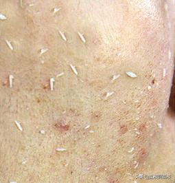 角质层损伤怎么修复,修复角质层的护肤品