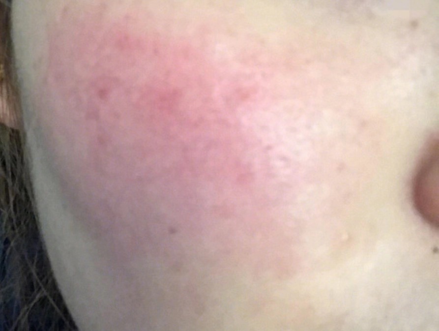 脸有血丝用修复精华液,红血丝泛红怎么修复