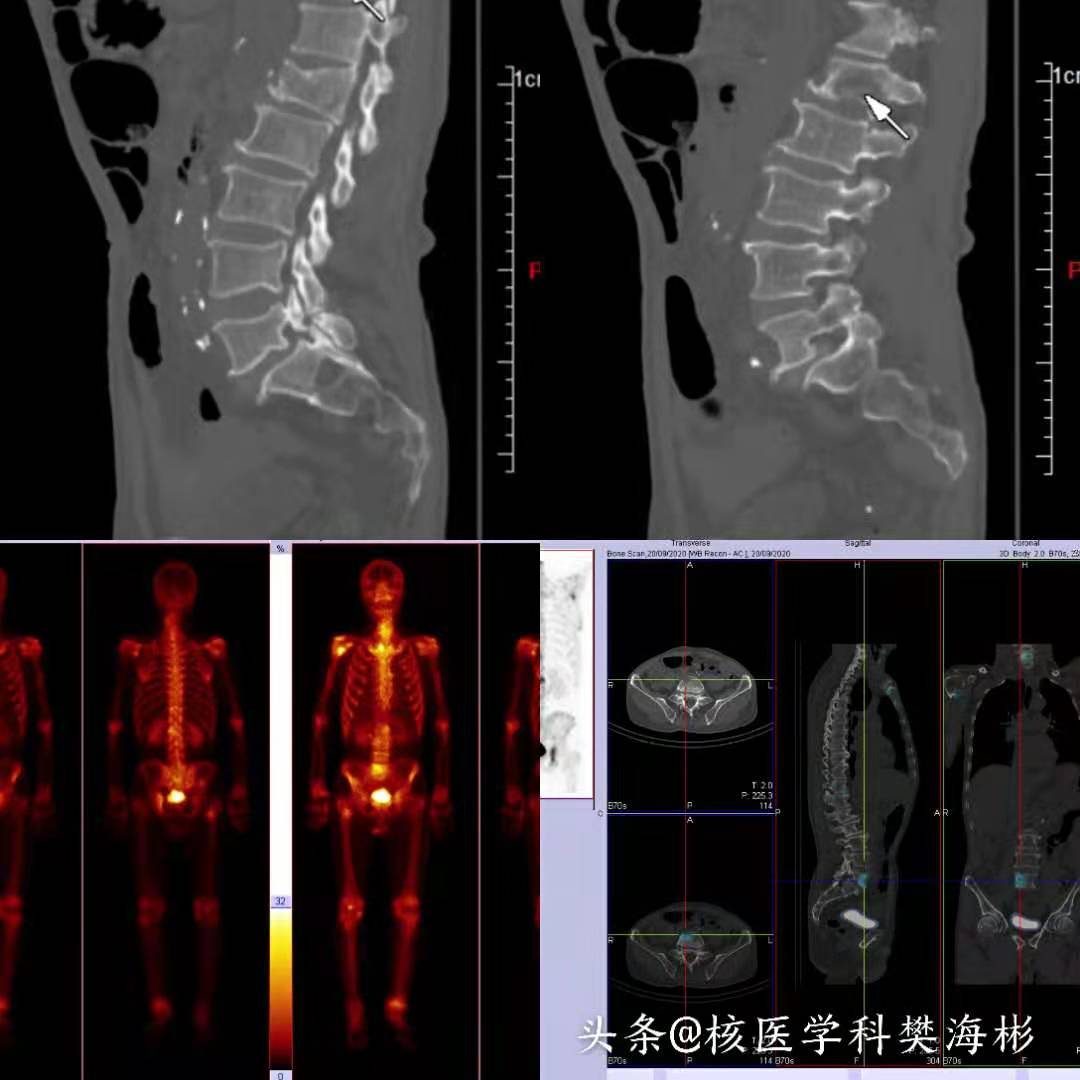 癌症骨转移有救吗,癌症发生骨转移还有救吗