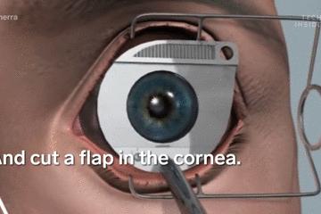 手术的时候医生对你做了什么,手术时切了一片肺叶