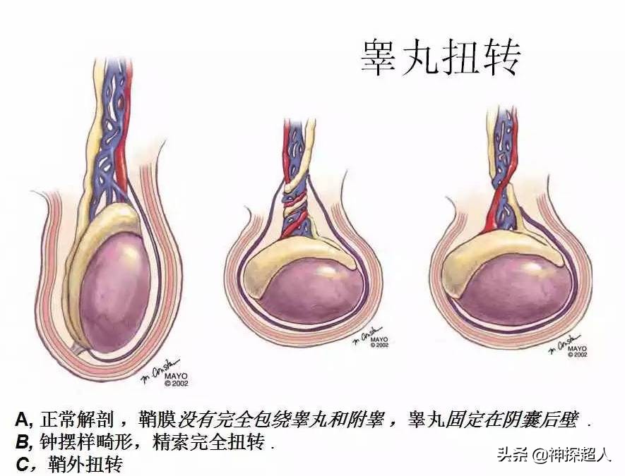 男性“蛋蛋”痛，必须引起重视，特别是一侧突发痛