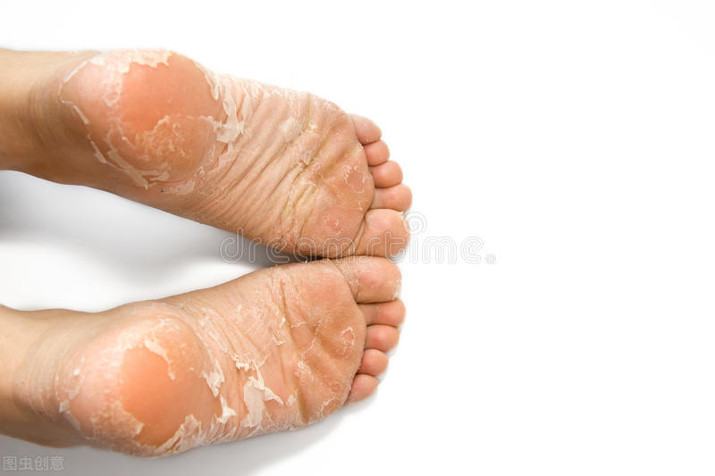 脚气怎么治专家现场演示,如何治脚气和脚汗