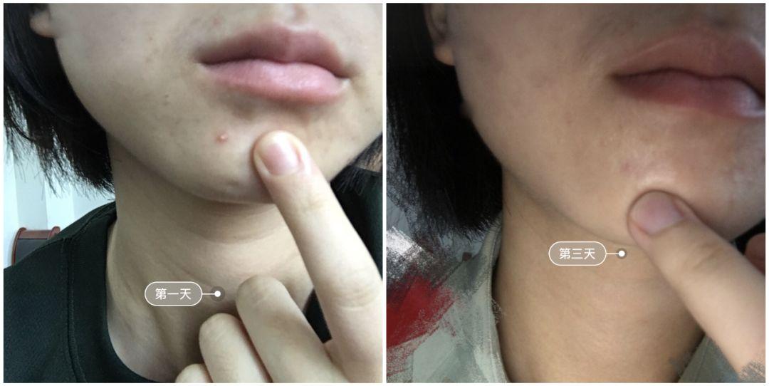 超好用的祛痘膏便宜,有没有好用的祛痘膏推荐女孩子