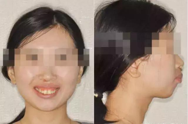 龅牙牙齿矫正的最佳方法,龅牙凸嘴露龈笑