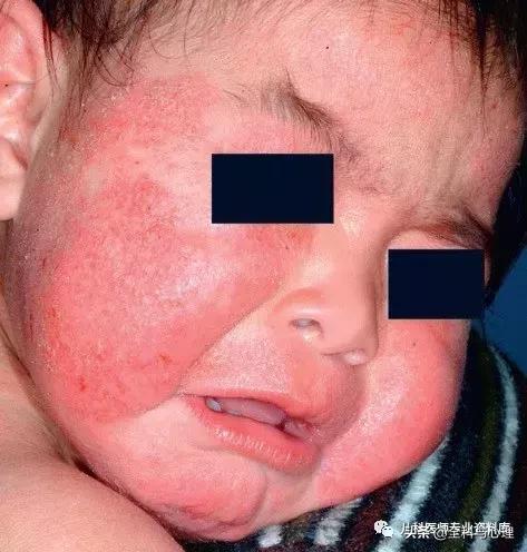 儿童痱子和湿疹，千万要分清楚了