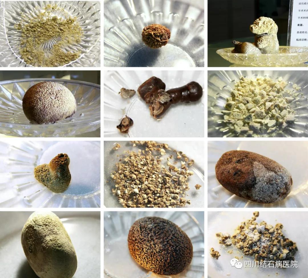 有胆结石要不要割,有胆结石要把胆囊全部切除吗