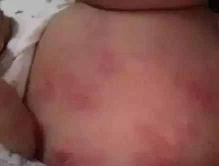 幼儿急疹和痱子怎么区分,宝宝急疹和痱子的区别